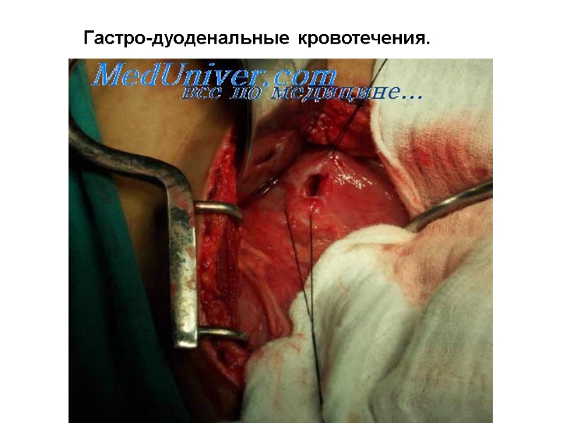 Гастро-дуоденальные кровотечения.